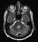 Dural AV Fistula, MRI