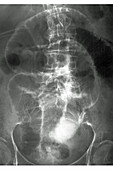 Chronic Colitis, X-ray