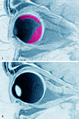 Retinal Detachment, MRI
