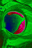 Retinal Detachment, MRI