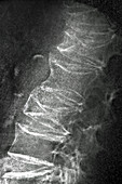 Spinal Osteoporosis, X-ray