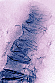 Spinal Osteoporosis, X-ray
