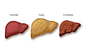 Liver Disease Progression, Illustration