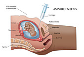 Amniocentesis, Illustration