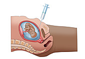 Amniocentesis, Illustration