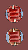 Colitis and the Large Intestine, Illustration