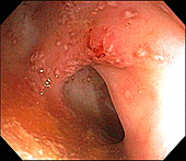 Moderate Ulcerative Colitis