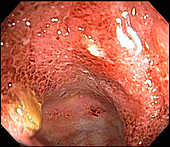 Severe Ulcerative Colitis