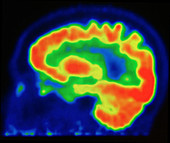 Brain, PET Scan, Normal