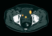 Bladder Cancer, CT Scan