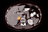 Adrenal Pheochromocytoma, CT