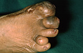 Leprosy, Abnormal Foot
