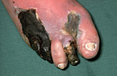 Gas Gangrene, Foot