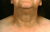 Hypothyroidism, Swollen Neck