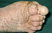 Hypothyroidism, Foot