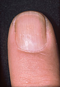 Psoriatic Arthritis, Fingernail
