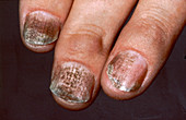 Psoriatic Arthritis, Fingers