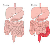 Healthy Digestive System and Colitis