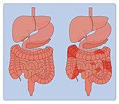 Healthy Digestive System & Crohn's, Comparison