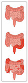 Crohn's Disease & Ulcerative Colitis, Comparison