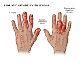 Psoriatic Arthritis with Lesions