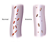 Red Blood Cells and Anaemia, Illustration