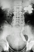 Renal Colic, X-Ray