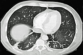 Pulmonary Infarction, CT Scan