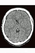 Cerebral Edema, CT Scan
