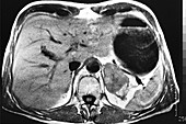 Malignant Adrenocortical Tumour, CT Scan