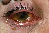 Staph Infection (Eye)