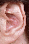 Whipples Disease (Ear)