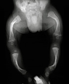 Brittle Bone Disease, X-ray