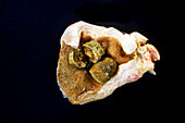 Gallstones