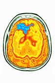 Cerebral embolism