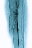 Fracture resulting from osteoporosis, X-ray
