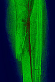 Fracture resulting from osteoporosis, X-ray