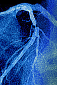 Myocardial infarction, angiogram