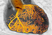 Myocardial infarction, angiogram