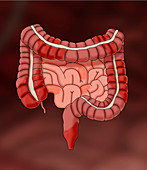 Crohn's Disease Possible Locations, Illustration