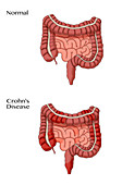 Normal & Crohn's Disease, Illustration
