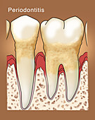 Periodontitis, Illustration