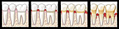 Progression of Gum Disease, Illustration