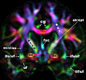 White matter brain tracts, DTI