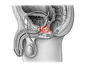Prostate Cancer, Illustration