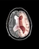 MRI Communicating Hydrocephalus (NPH)