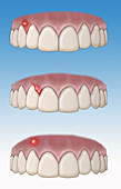 Types of Dental Abscesses, Illustration