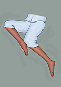 Restless Leg Syndrome, Illustration