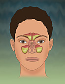 Sinusitis, Illustration