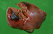 Ruptured liver